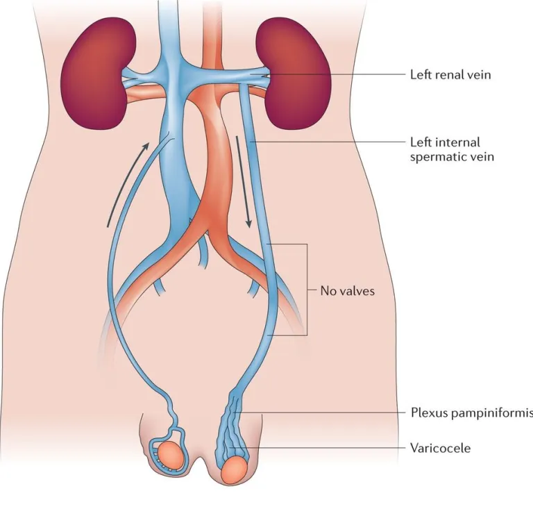 Varicocel embolization procedure diagram 3